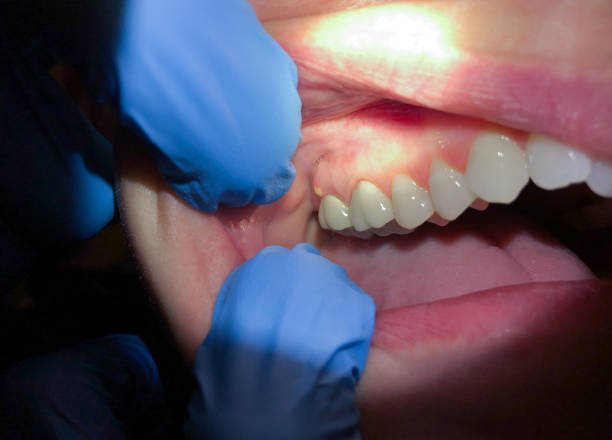 Best Broken or Cracked Tooth Emergency Dentist in Purvis, MS